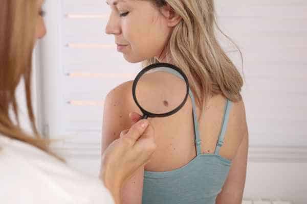 What Are Traditional Skin Lesion Removal Methods Nottinghamshire?