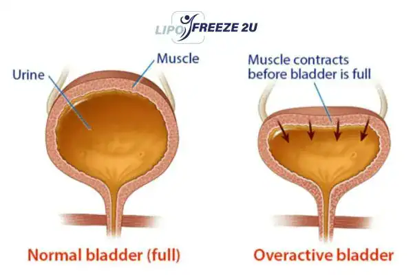 diagram of overactive bladder treatment Nottinghamshire