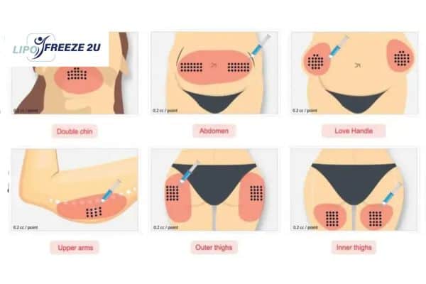 Benefits of Choosing Aqualyx for Fat Reduction Nottinghamshire