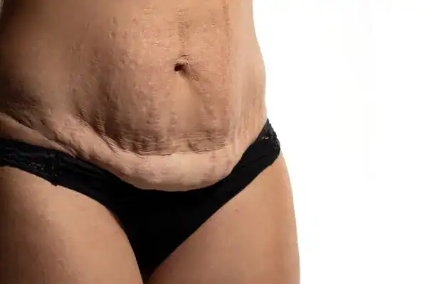 loose skin after weight loss injections Nottinghamshire