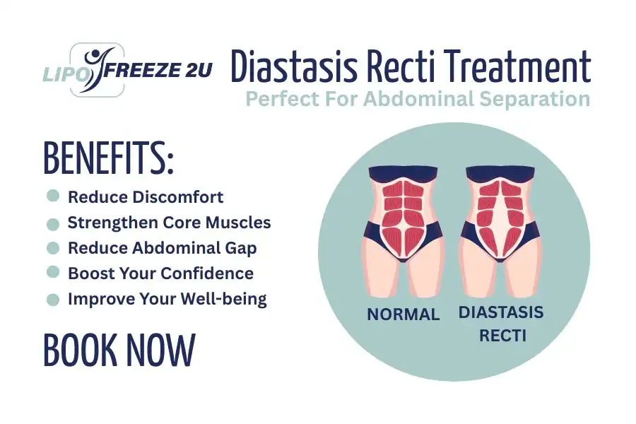 How Long Will It Take to See Improvements in Diastasis Recti Nottinghamshire