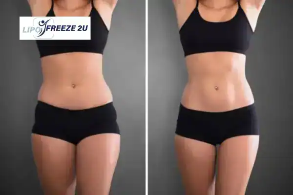 How Can LIPO FREEZE 2U Support Your Post-Pregnancy Body Recovery Nottinghamshire?
