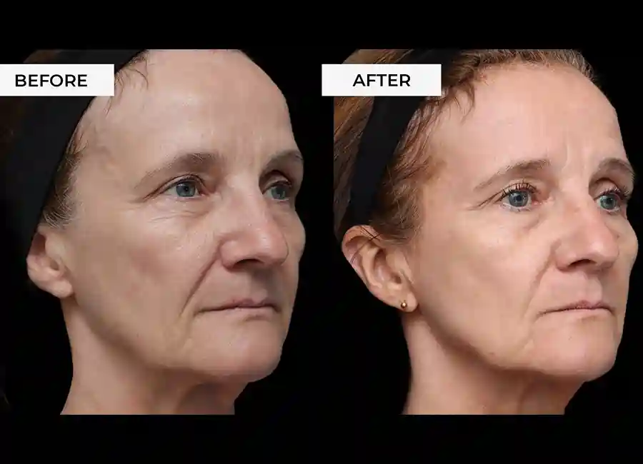 How Many RF Microneedling Sessions Will You Need to See a Difference Nottinghamshire?