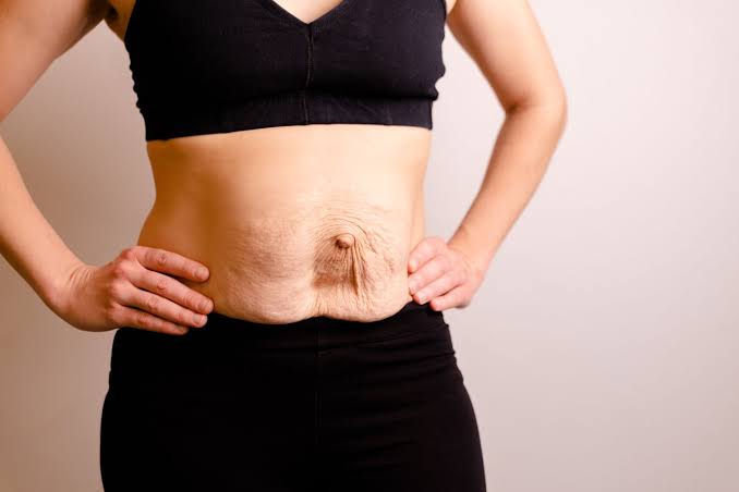 Is Surgery Really the Only Way to Repair Diastasis Recti Nottinghamshire?