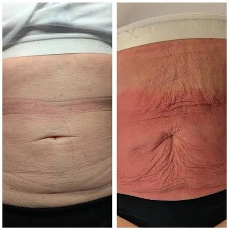 How Does RF Microneedling Improve Crepey, Thin and Uneven Skin Texture Nottinghamshire?