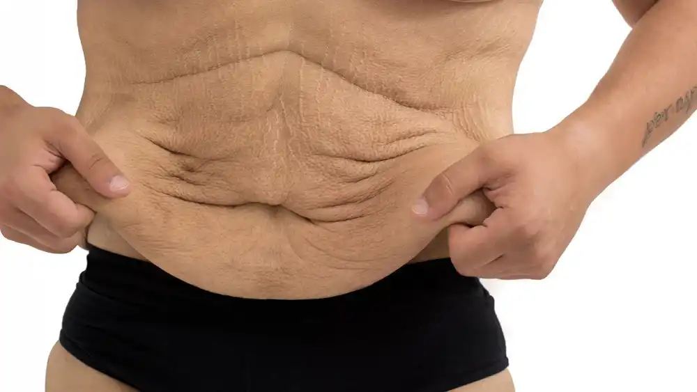 Why Does Weight Loss Medication Leave Some People With Loose or Sagging Skin Nottinghamshire?